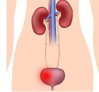 Causes -Security Cystitis in Women