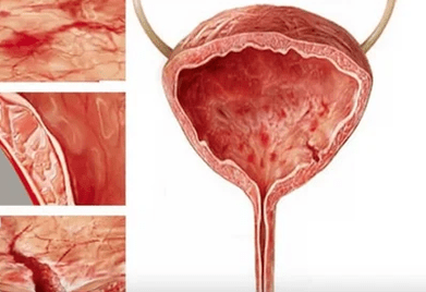 Causes -Security Cystitis in Women
