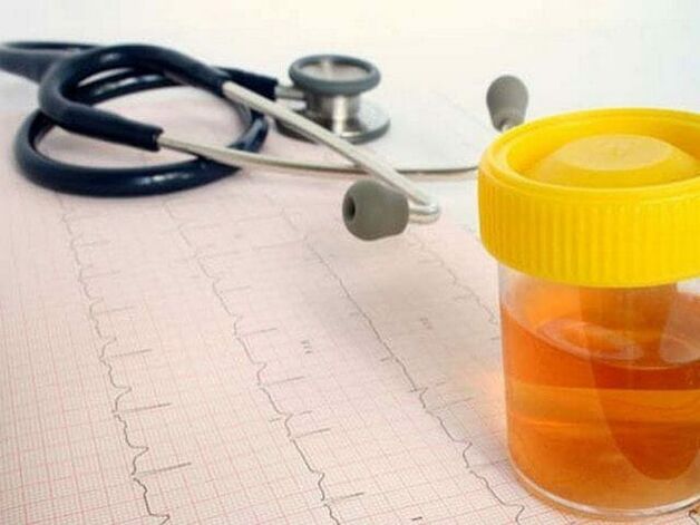 Urine analysis to diagnose cystitis